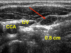 ultrasound of thyroid