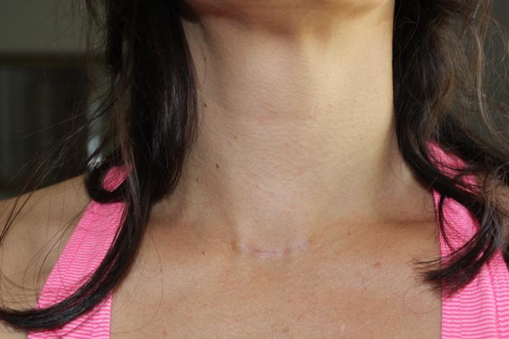 Incision one month following thyroid cancer surgery