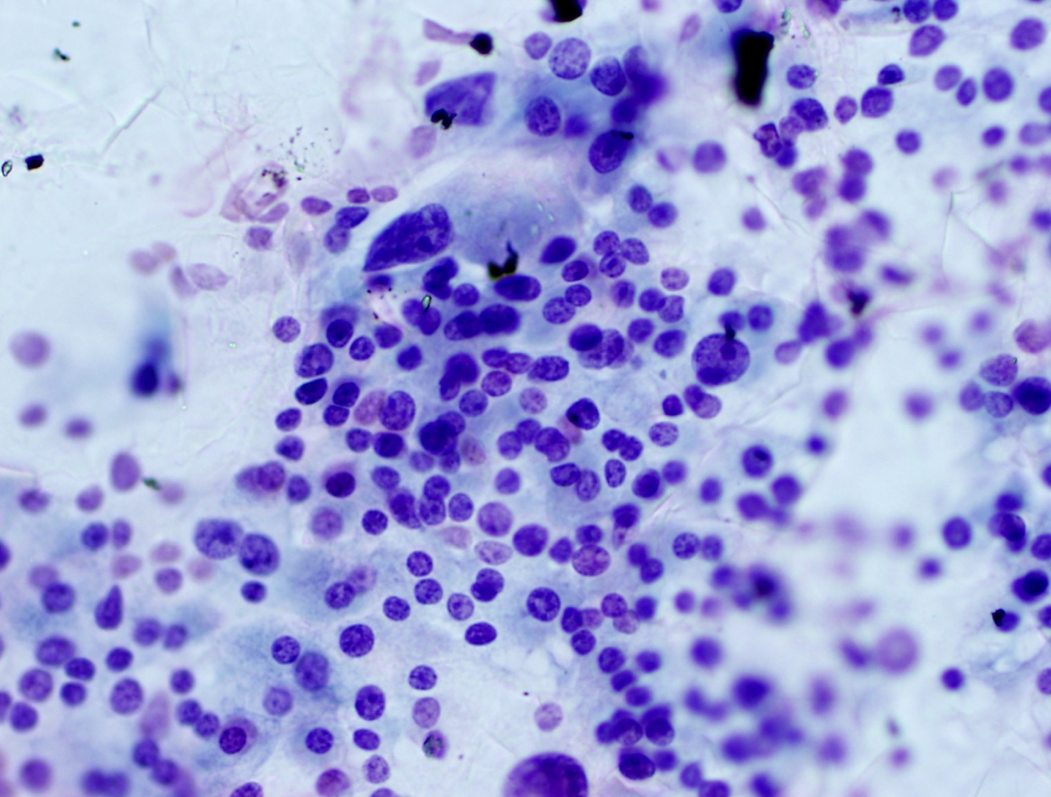 A thyroid cytology slide showing a good sampling of thyroid cells.