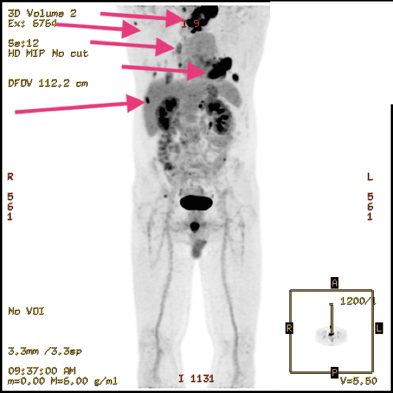 PET scan anaplastic thyroid cancer