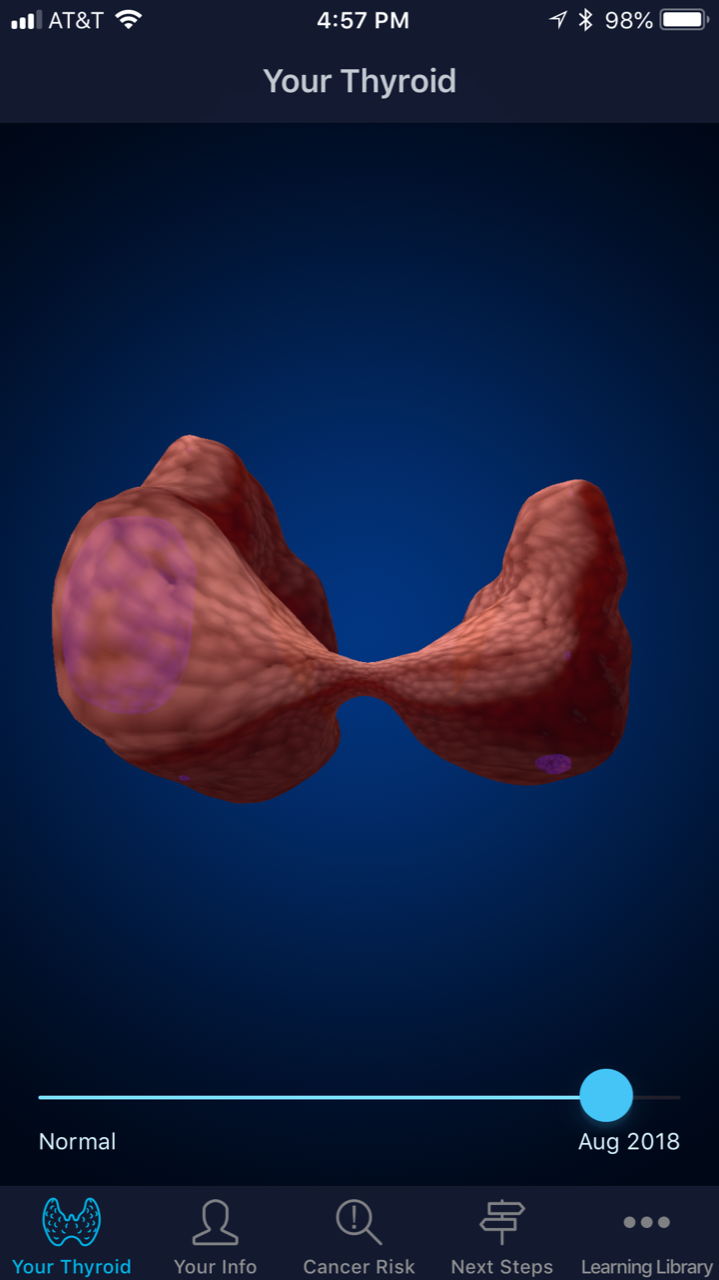 Thyroid Nodule in 3D