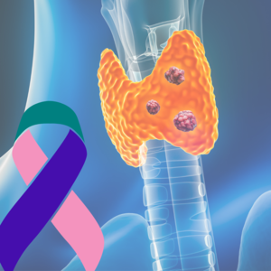 Understanding+tall+cell+variant+of+papillary+thyroid+cancer