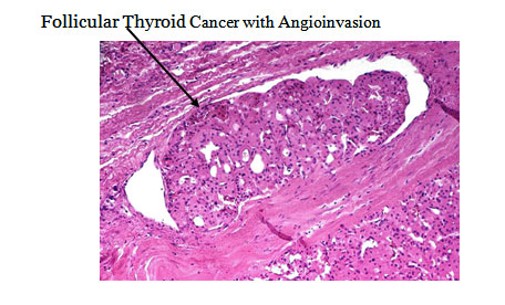 thyroid follicular carcinoma