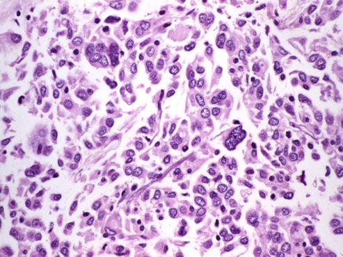 anaplastic carcinoma