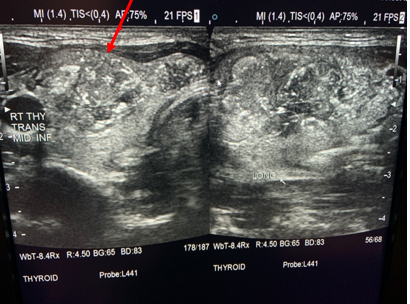 thyroid cancer ultrasound