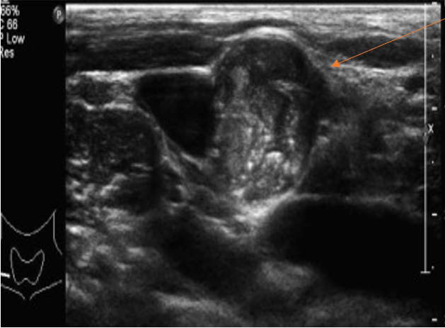 normal thyroid ultrasound