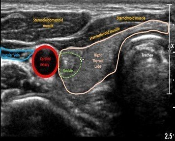 normal thyroid ultrasound