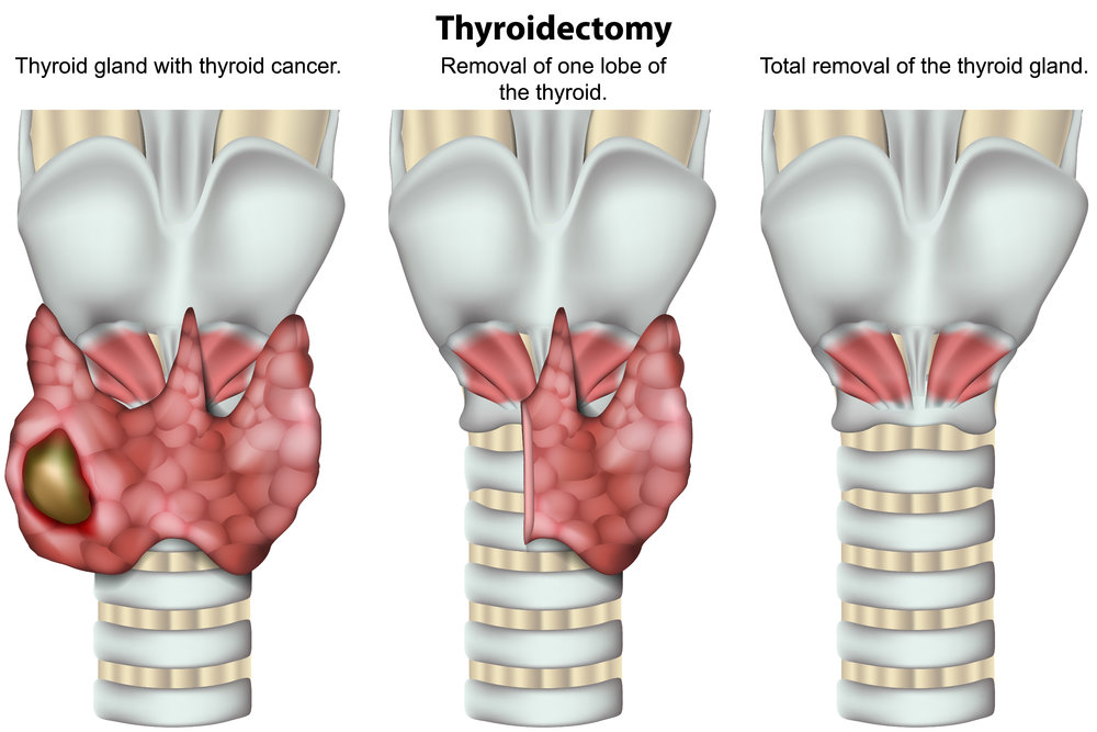 thyroid nodules removal