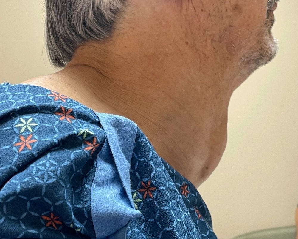 swollen neck thyroid