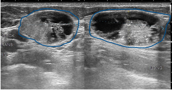 can an ultrasound miss thyroid cancer